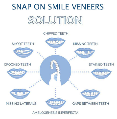 Smile Veneer Set for Upper and Lower Teeth – Instant Smile Transformation with Custom Fit 5