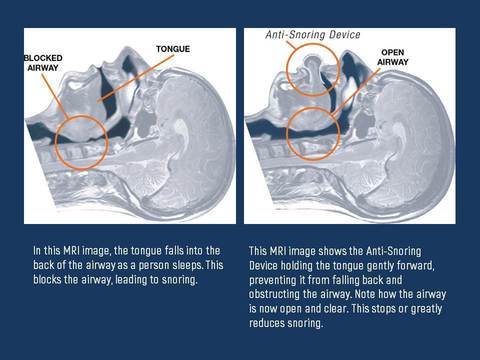 Anti-Snore Tongue Stabilizing Device – Non-Invasive Solution for Sleep Apnea and Snoring 3
